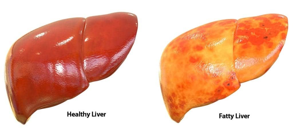  건강검진 지방간(Fatty Liver) 지방간은 뭐길래 4편
