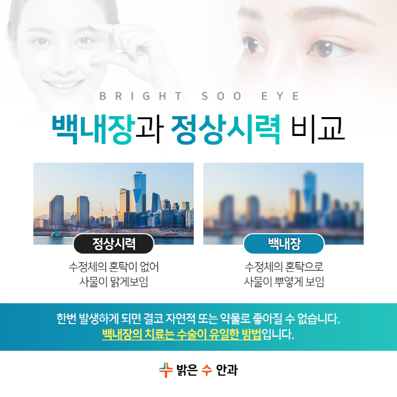 ●원인부터 알아보자, 서면 백내장 수술