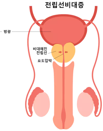 전립선비대증