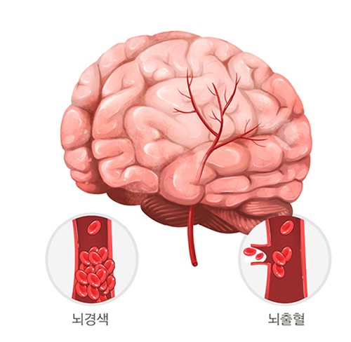뇌경색과 뇌출혈을 나타낸 그림