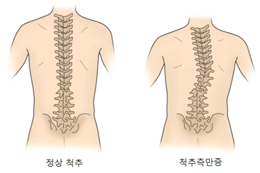  척추측만증 증상/원인/수술/교정