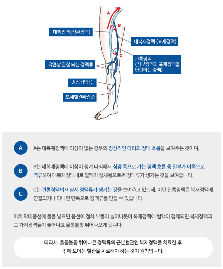 정맥류 수술 비용은?50대 여성의 힐링 스토리 6