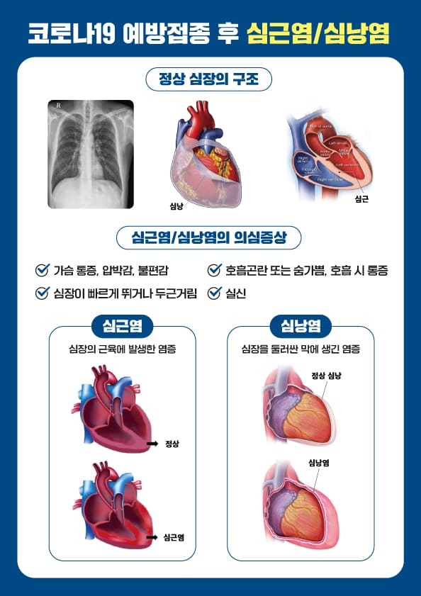 내과의사가 알려주는 백신 심근염 예방 및 치료법