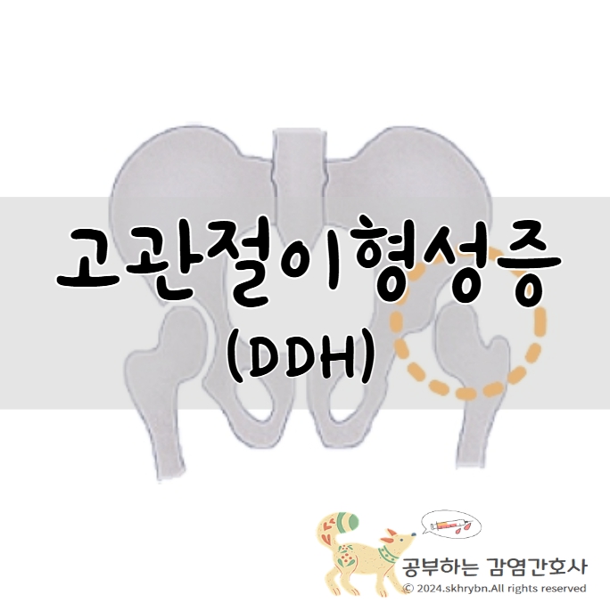 고관절 이형성증 (Developmental Dysplasia of the Hip, DDH)