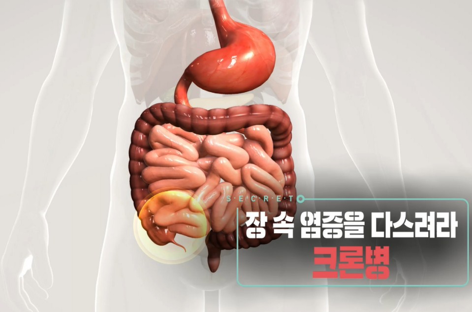  생로병사의 비밀 만성염증 질환 크론병 약 알아보기