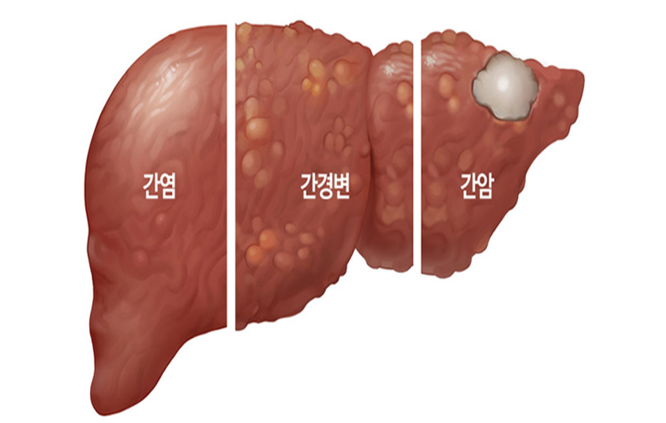 간염에서 간경변에서 간암으로 진행