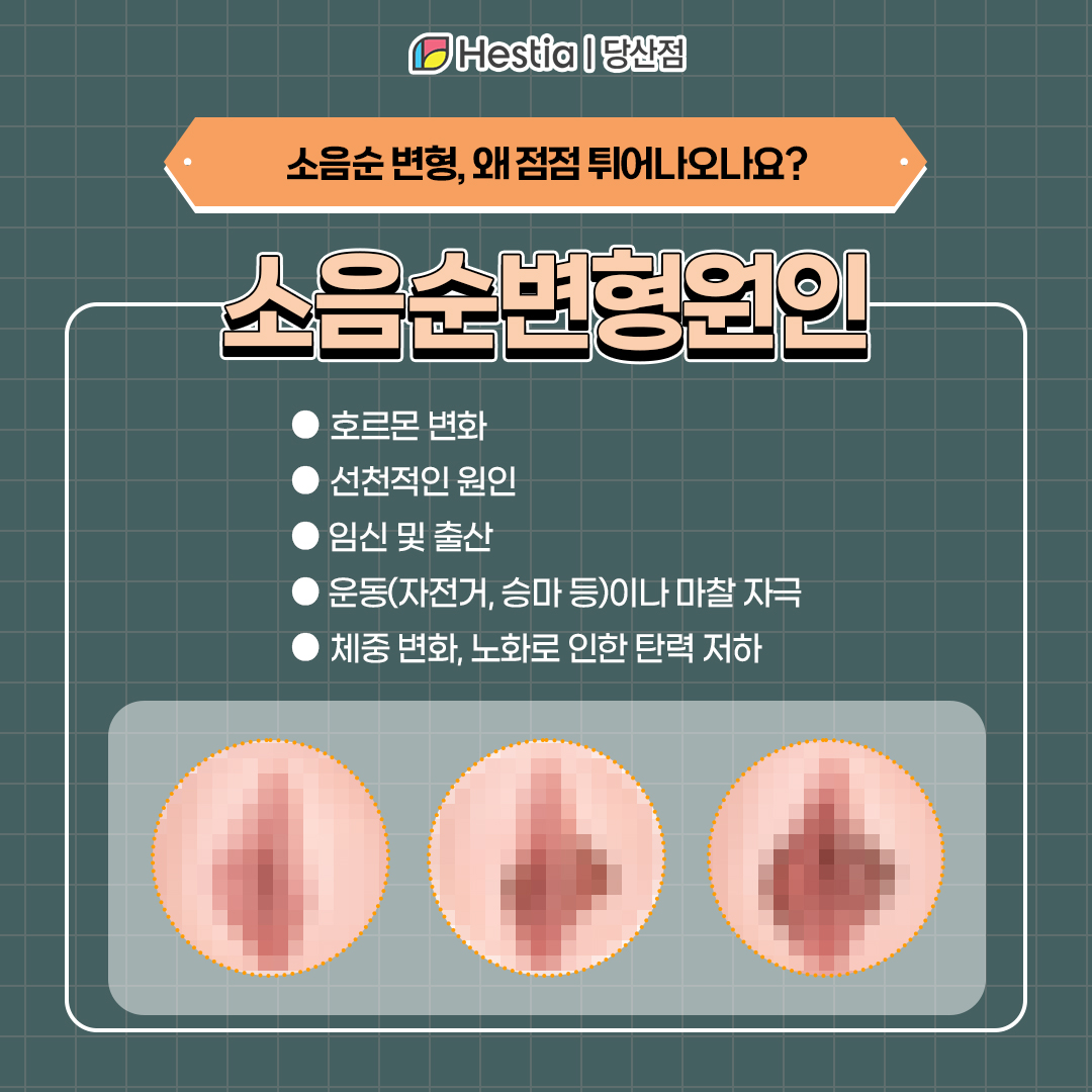 소음순변형, 왜 점점 소음순돌출이 될까?