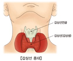 갑상선 기능 항진증 증상3