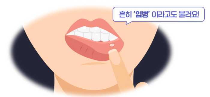 구내염