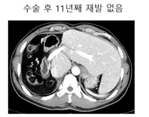 간암도 완치가 있나요?(세브란스 김도영 교수 1문 1답)