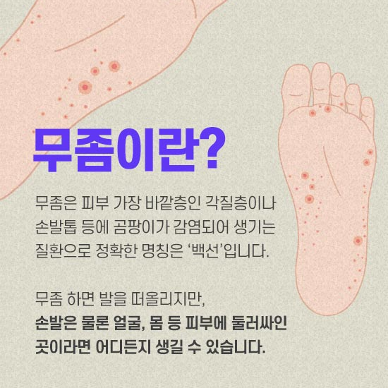 무좀 예방법&amp;#44; 원인 치료법