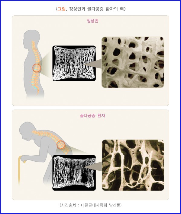 골다공증 뼈 구조