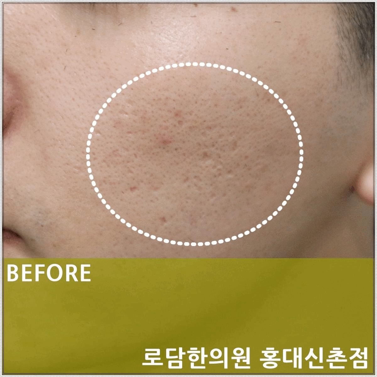  일산 여드름 흉터 피부과 아닌 한의원 패인 자국 새살침 치료