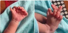 손&middot;발가락 26개로 태어난 인도 아기