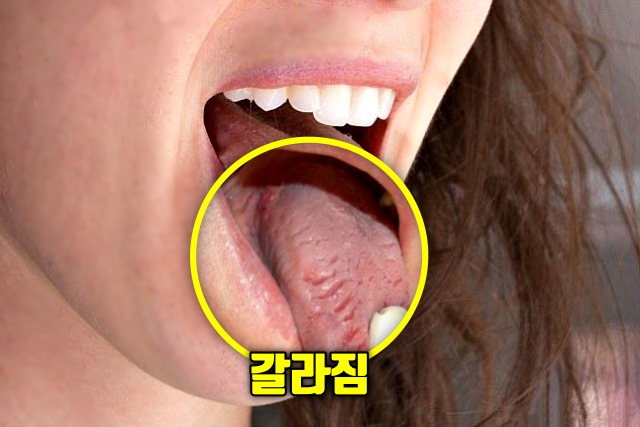 혀 가장자리 갈라짐 혀가 갈라지는 이유 자가면역질환
