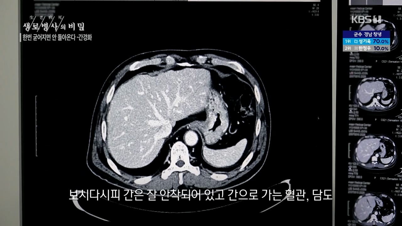 생로병사의 비밀.E863.230406p.H264-F1RST.mp4_20230406_202532.264.jpg