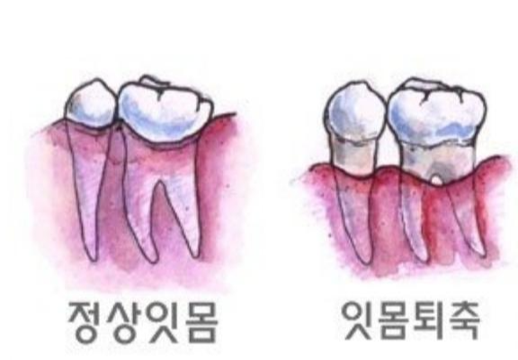 치아교정 부작용