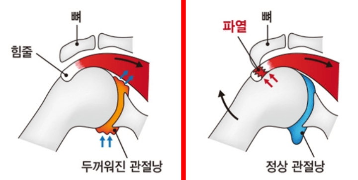 회전근개-파열-오십견