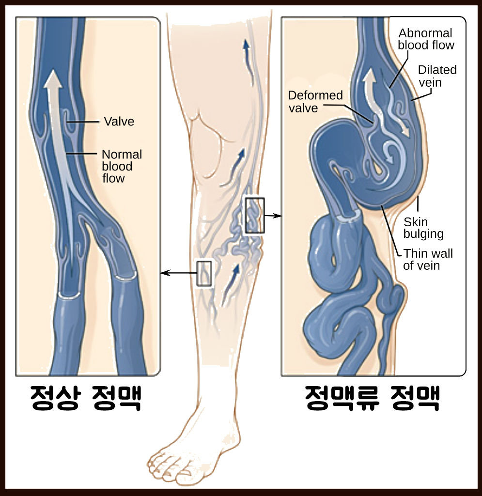 정맥류 수술 비용은?50대 여성의 힐링 스토리 14