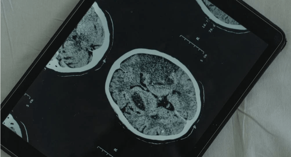 뇌출혈 CT