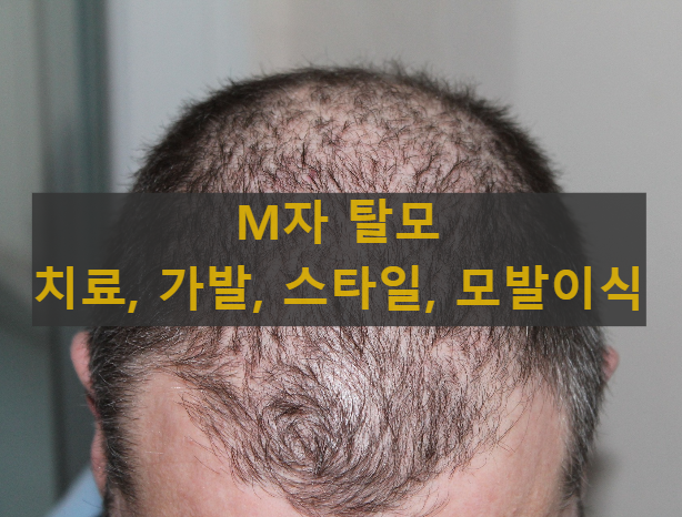  M자 탈모 치료, 치료제, 가발, 헤어스타일, 모발이식 비용, M자 이마