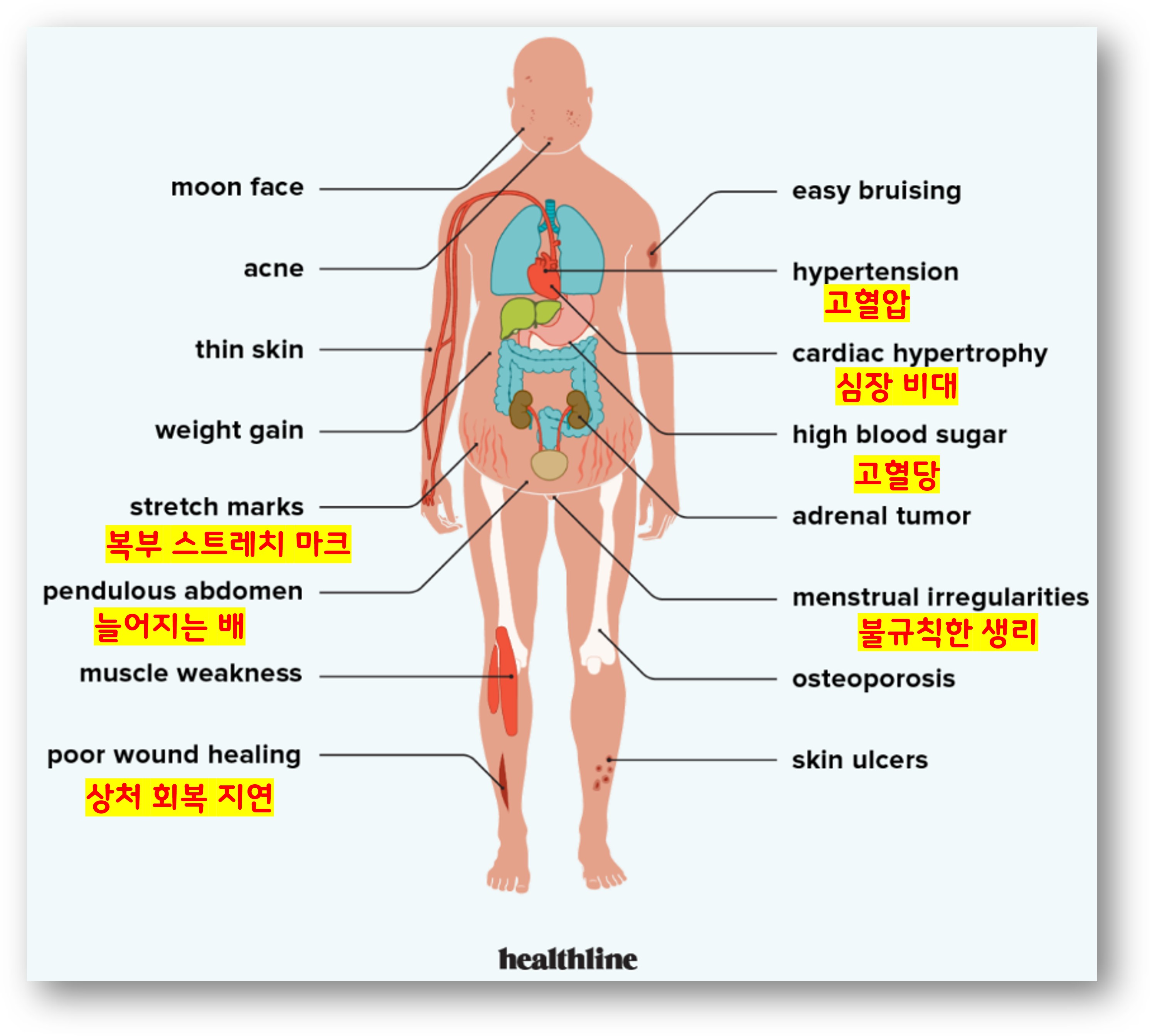 쿠싱 증후군 증상 f. healthline