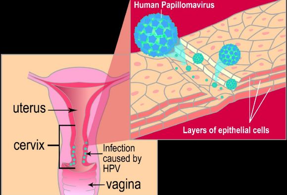 인유두종 바이러스 원인