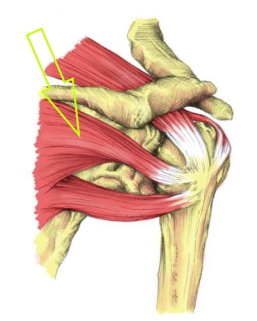 회전근개 근육중에 극하근에 화살표가 있는 그림