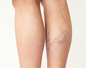 Worm-Like Veins and Leg Swelling: Understanding the Causes and Treatments of Varicose Veins.