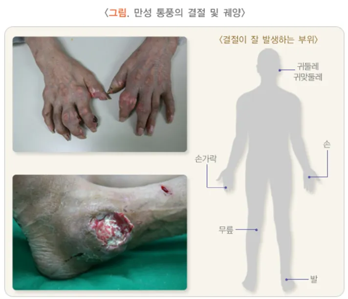 만성통풍-손가락관절-변형사진