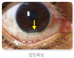 포도막염-원인-설명하는-사진