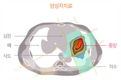 정상세포 피해 최소화