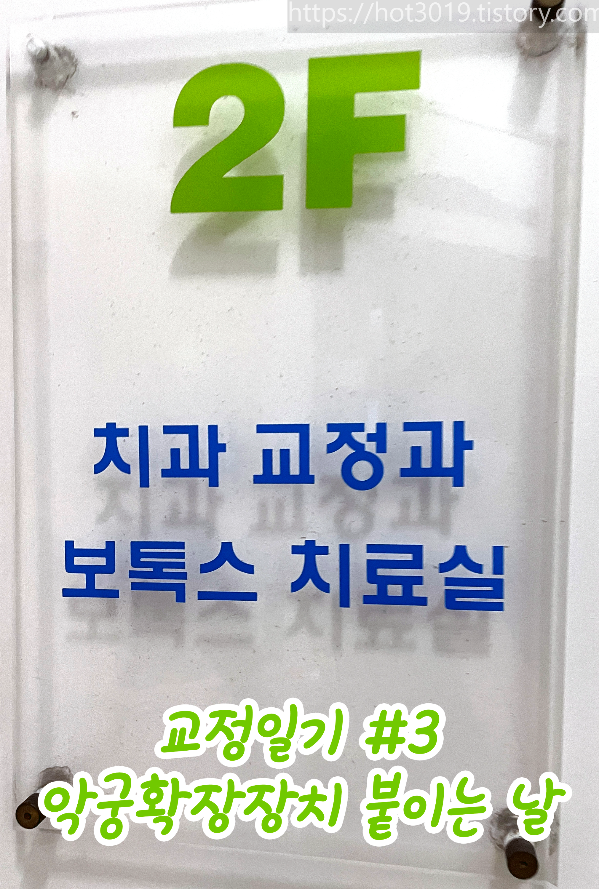  상악궁확장교정 장치 부착 - 교정일기 #3 , 구올담치과