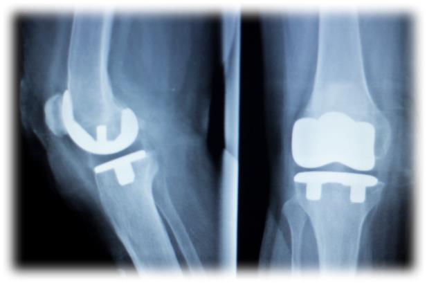 인공지능 기반 고관절 및 무릎 수술: 혁신의 가능성과 고려해야 할 점