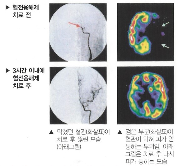 혈전용해제 치료