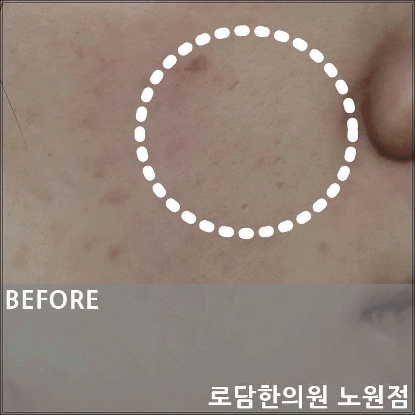  노원 여드름 흉터 관리 패인 자국 제거 새살침