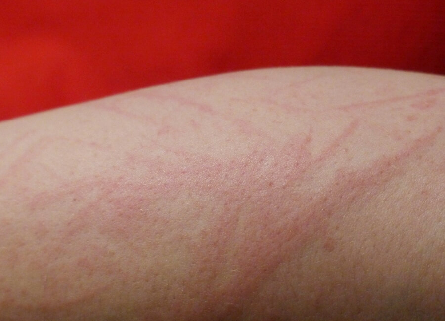 붉은염증과-가려움증이-동반된-피부