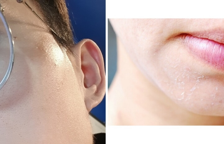 왼쪽지성피부사진과 오른쪽건성피부사진