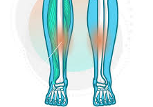 종아리-근육-통증-경골스트레스-증후군