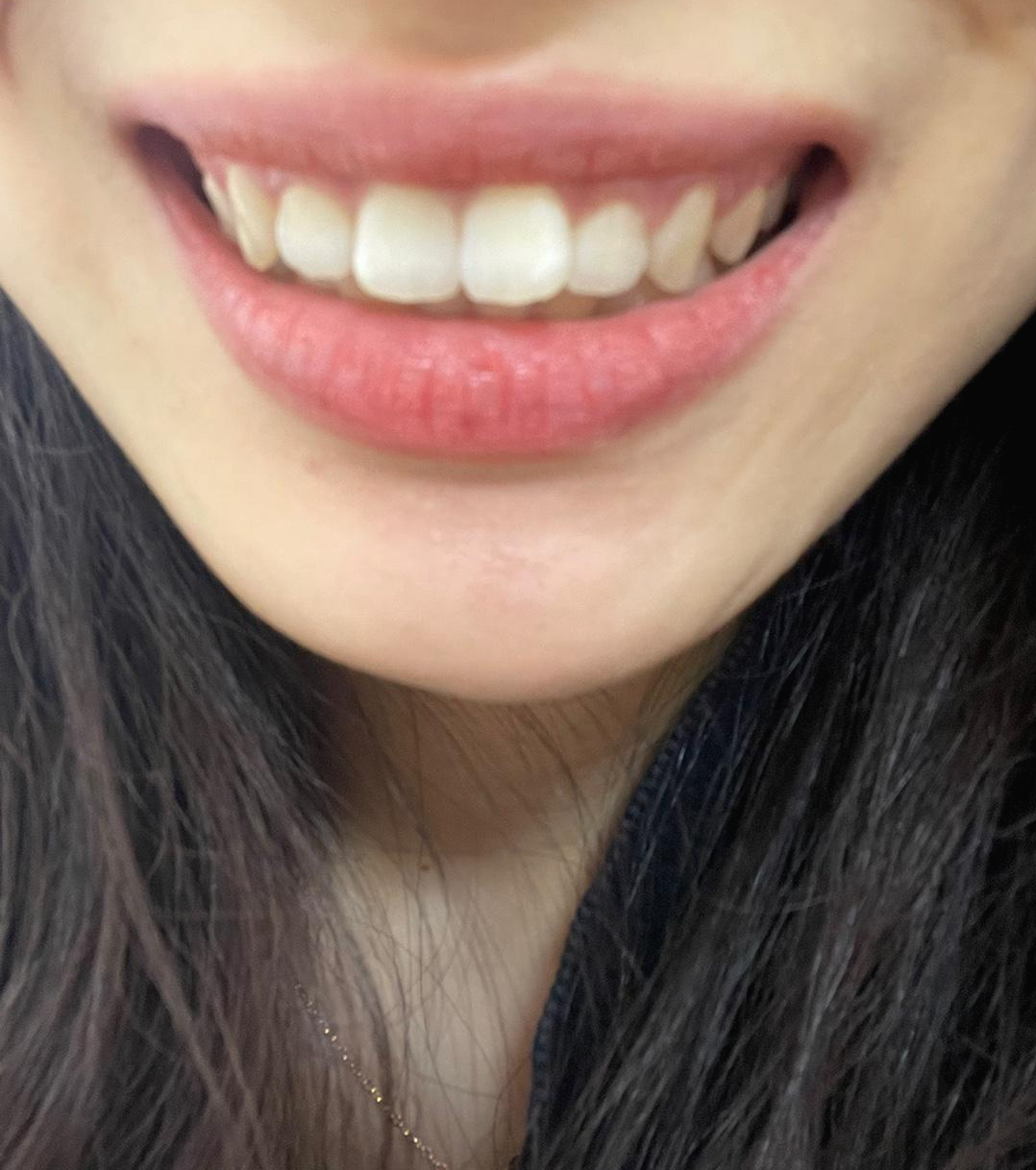 [내돈내산] 광주앞니 부분교정 후기 #첫번째 상담후기