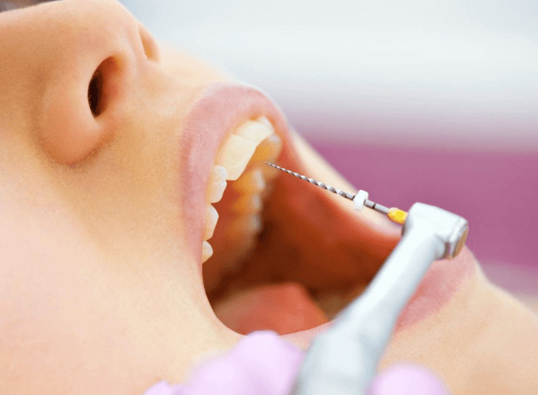 치아 신경치료 방법