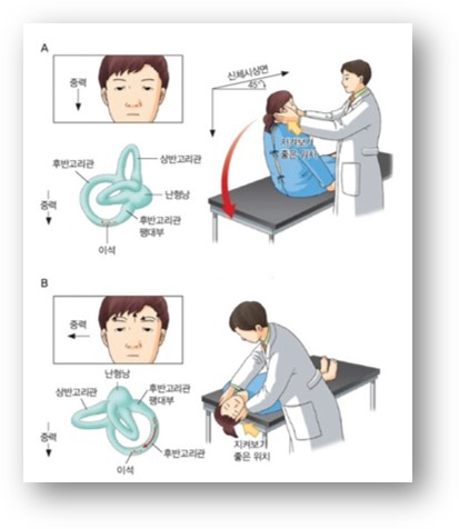 딕스홀파이크 검사 The Dix-hallpike test