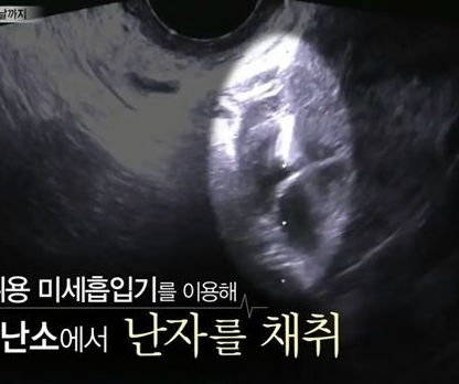  결혼시기가 늦어지는 현재 사회문제가 되어가는 난임 부부 이야기