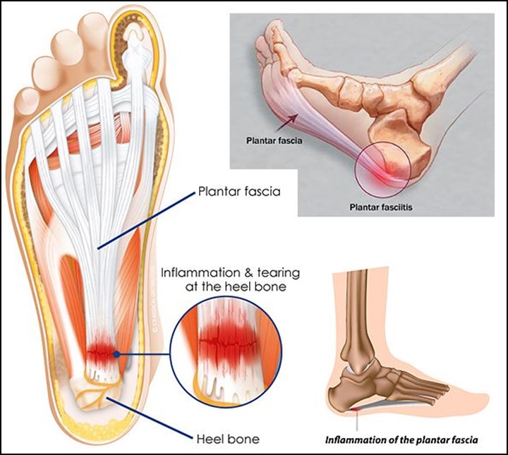 족저근막을 나타내는 그림으로 발 뒤꿈치 부위에 손상이 있는 그림