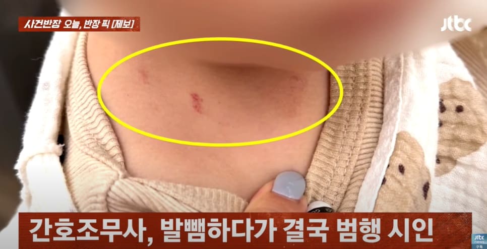 A baby&#39;s bruised nape