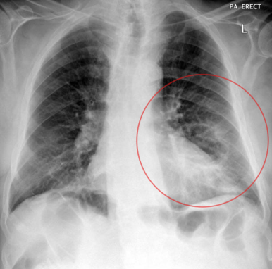 폐편평세피암종의 xray