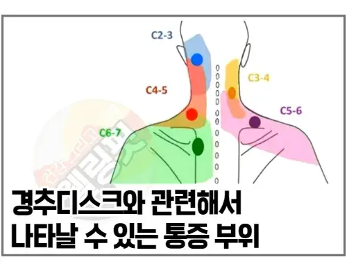 경추디스크의-연관통