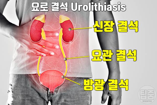 소변 볼때 따가움 따끔 따가워요 요로결석