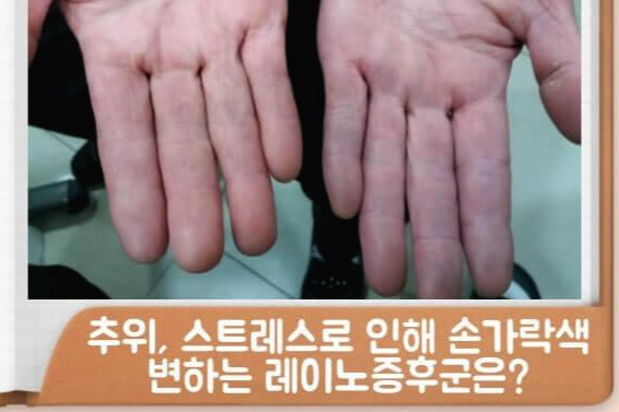 실제로 레이노 증후군 증상이 일어났을 때의 손가락의 사진을 찍어 두고, 진찰시에 의사에게 보여주면 설명하기 쉽습니다.