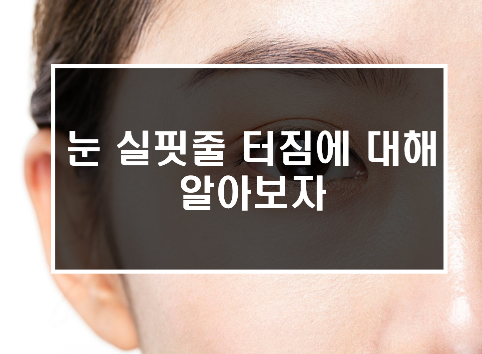  눈 실핏줄 터짐에 대해 알아보자